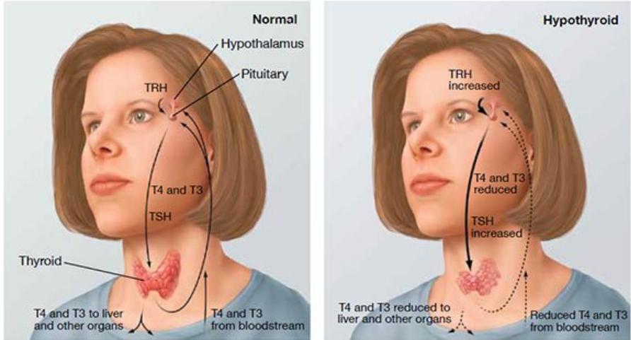 Symptoms of hypothyroidism