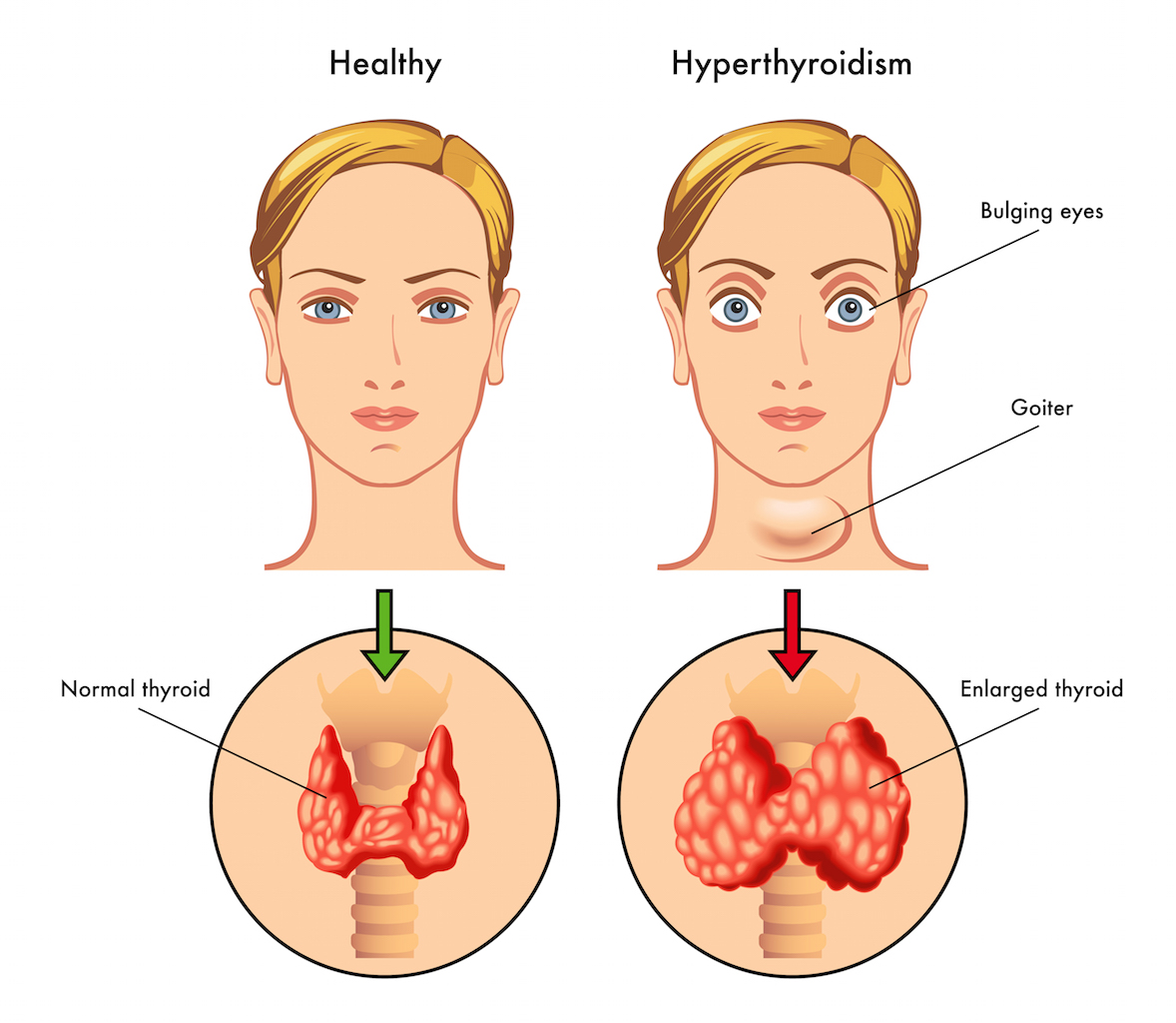 hyperthyroidism