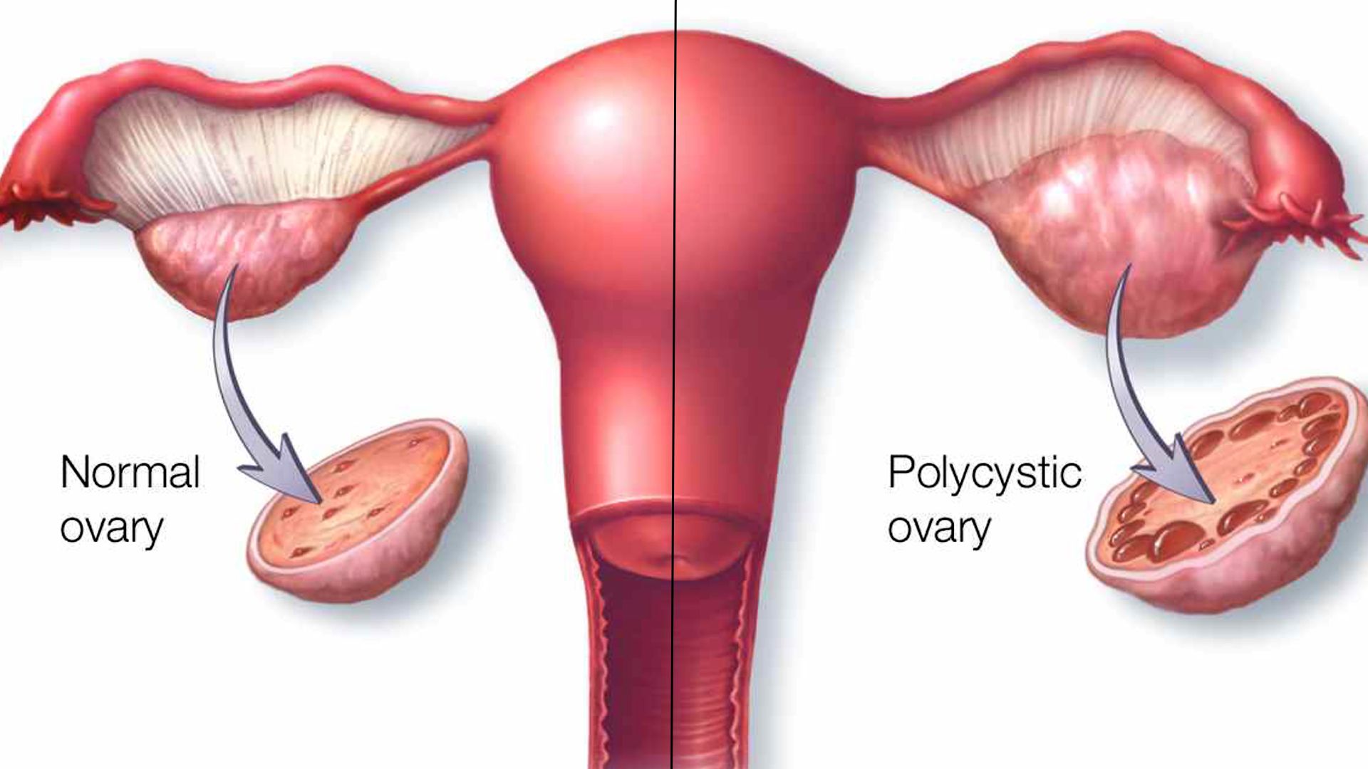 polycystic-ovary-syndrome-pcos