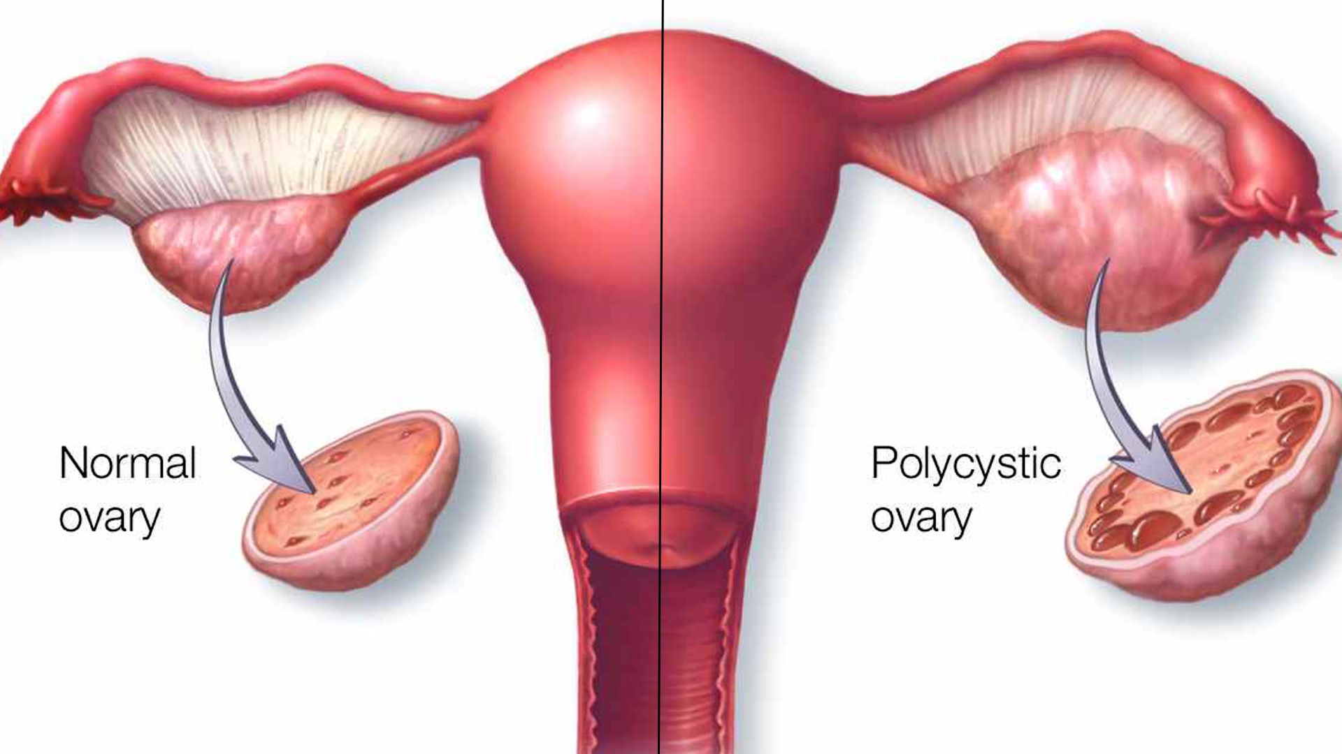 Lifestyle and Illness: Uterine Fibroids and Ovarian Cysts - Ayoti ...